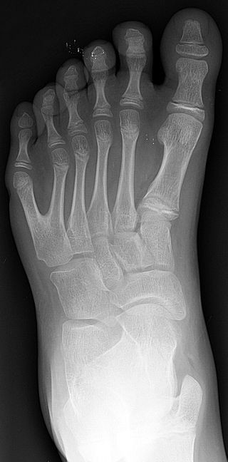 320px Polydactyly 01 Lfoot Ap