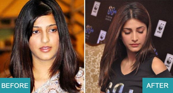 Surgery Actresses of bollywood (4)