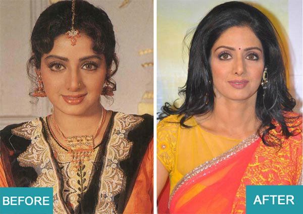Surgery Actresses of bollywood (9)