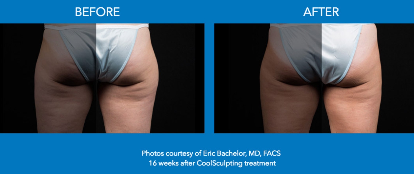 Coolsculpting on thighs before and after