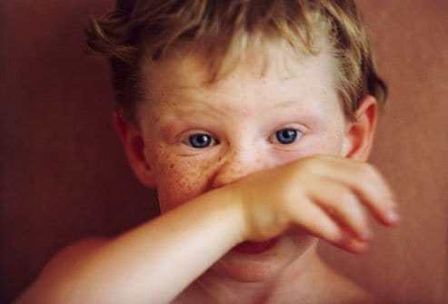 Signs of Mold Allergies In Children And What to Do About ...