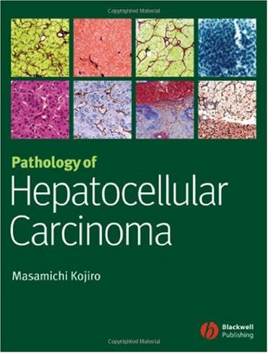 Pathology of Hepatocellular Carcinoma