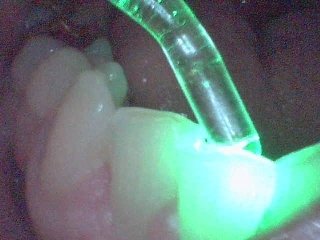 Low Level Lasers for Dental Treatment and Illumination